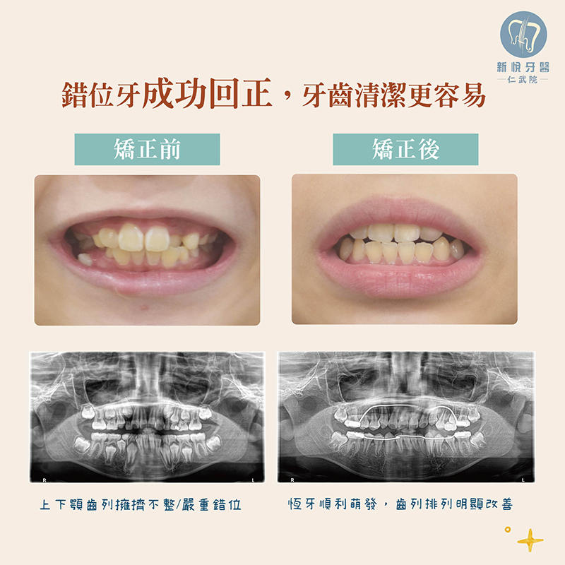 兒童矯正困難案例｜小佑的恆牙萌發挑戰的第5張圖片